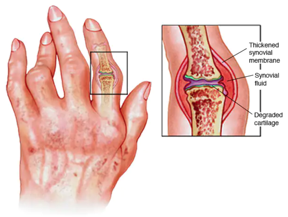 Assistive Tecnology for People With Arthritis