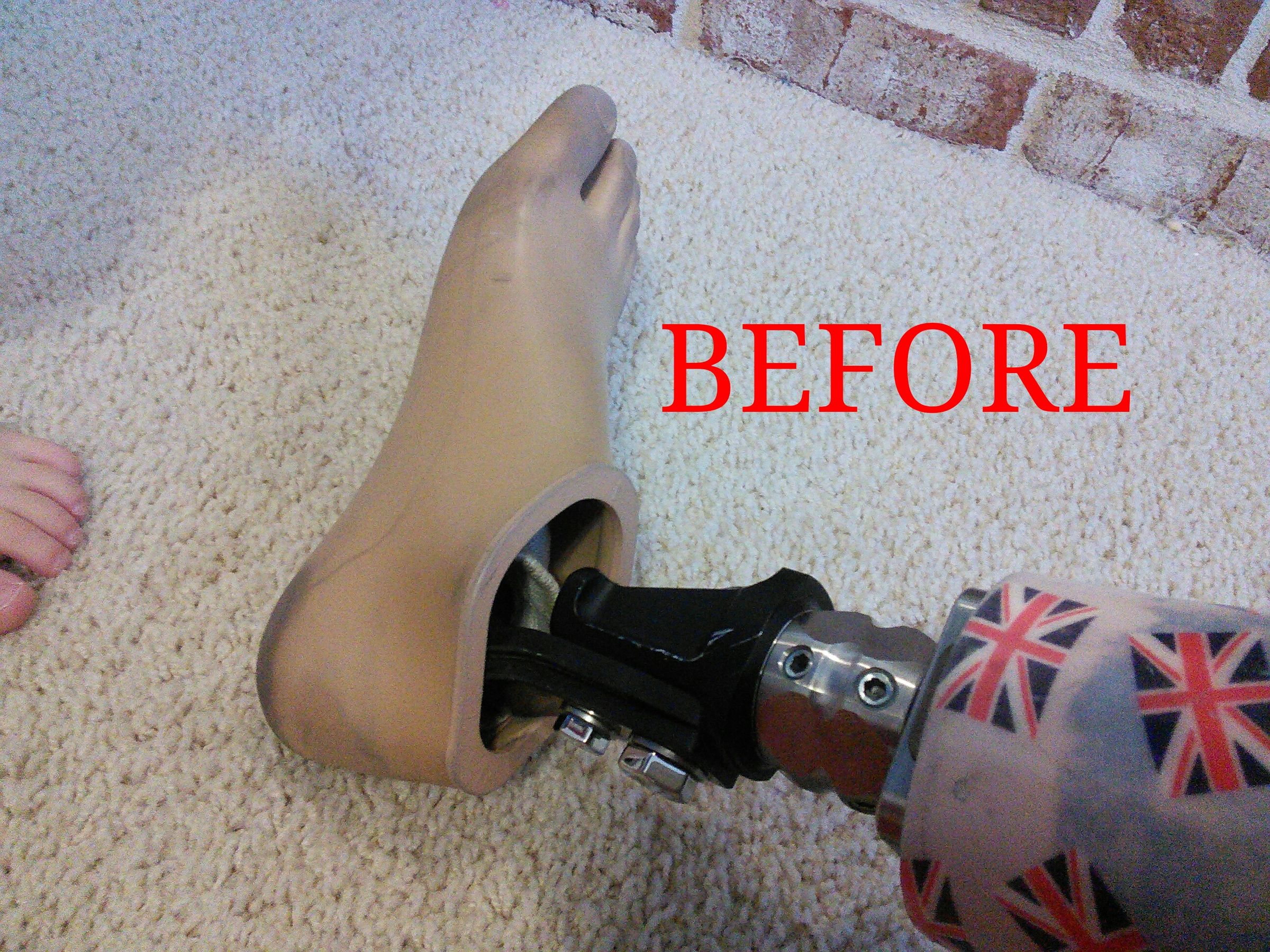 How to Put a New Foot on Your Prosthesis.