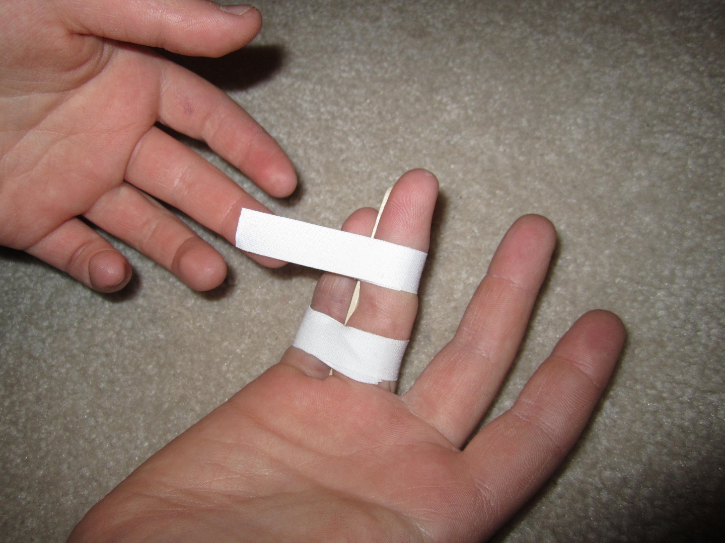 Aggregate more than 133 diy ring splints best xkldase.edu.vn