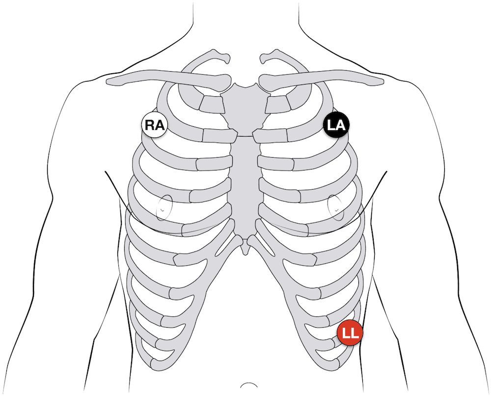 CardiaCARE Cardiac Rehab Fall Detector ECG Case 5 Steps cardiacare-cardiac-rehab-fall-detector-ecg-case-5-steps
