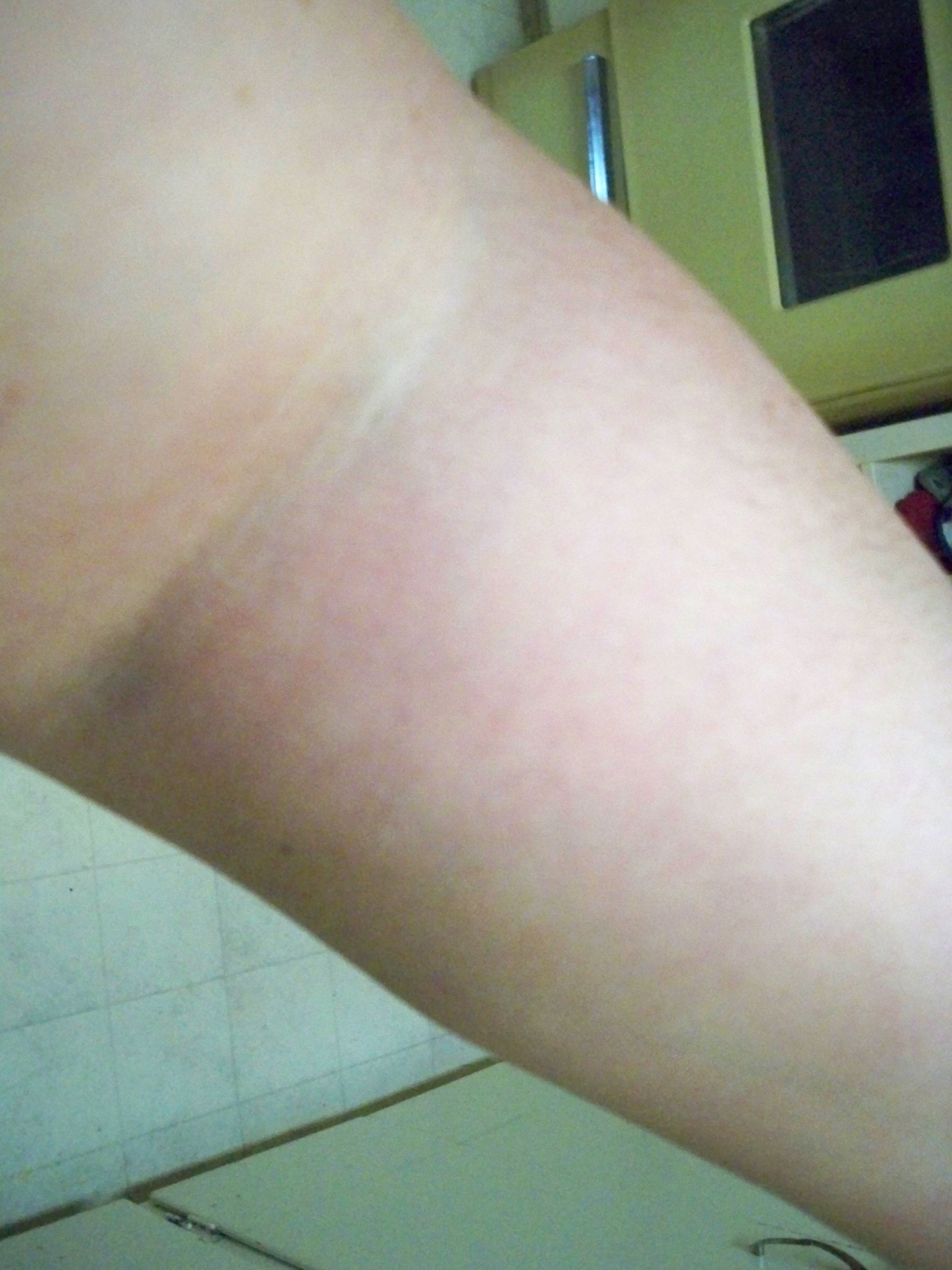 Fibromyalgia Arm Pain Relief!