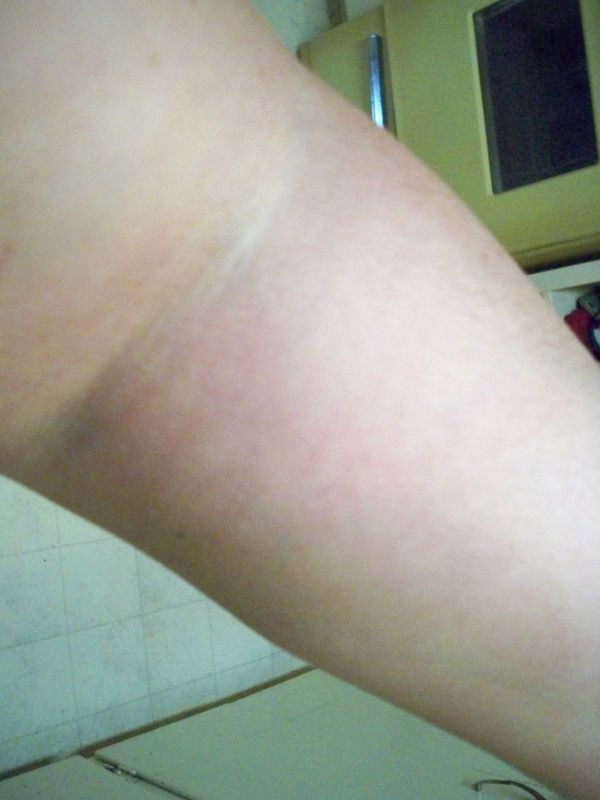 Fibromyalgia Arm Pain Relief!