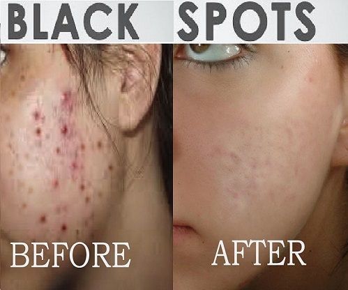 How to Clear Acne Marks | Dark Scars | Pimple Spots , Get Clean Face Skin 
