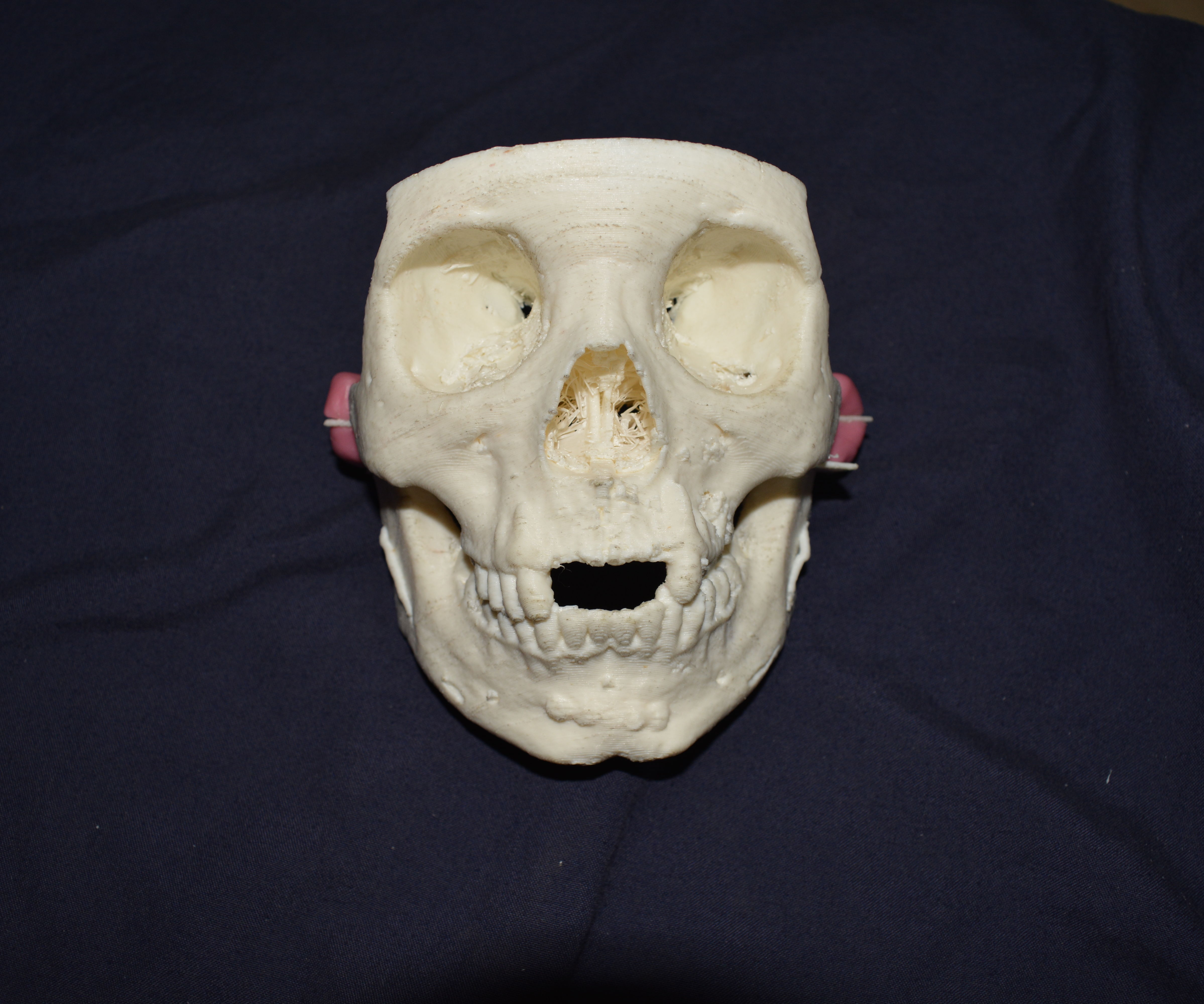 Surgical Guides for Temporomandibular Joint Ankylosis Surgery