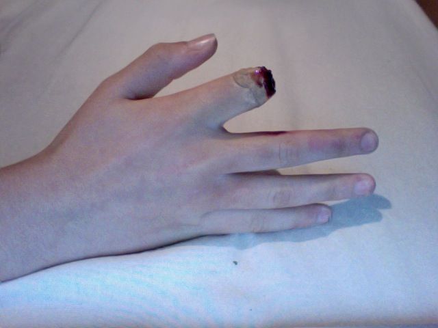 Bloody Finger Stump!