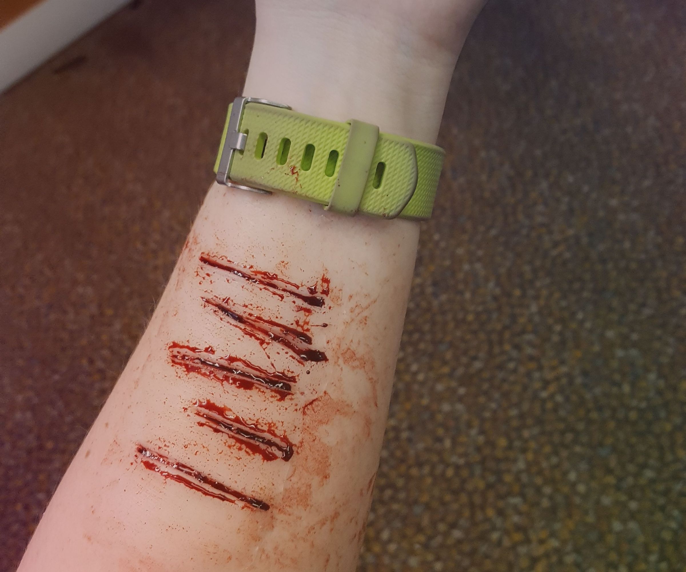 Simple Prosthetic Mold Creation