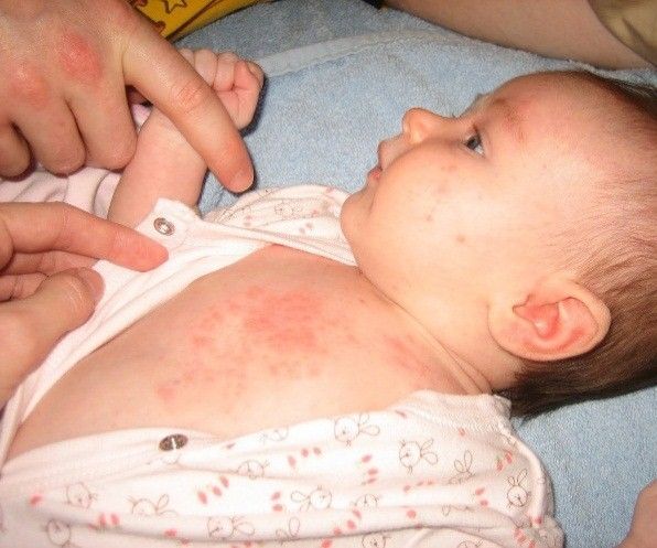 10 Home Remedies for Prickly Heat Rash or Miliaria
