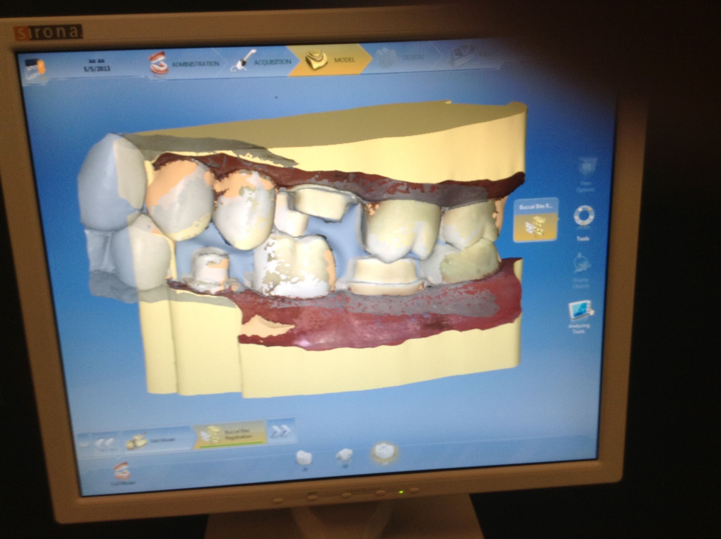 How to Fix a Tooth With CAD/CAM (CEREC) : 9 Steps (with Pictures ...