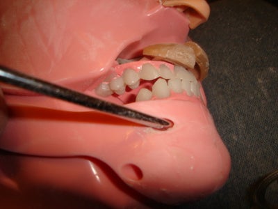 Jaw Removal