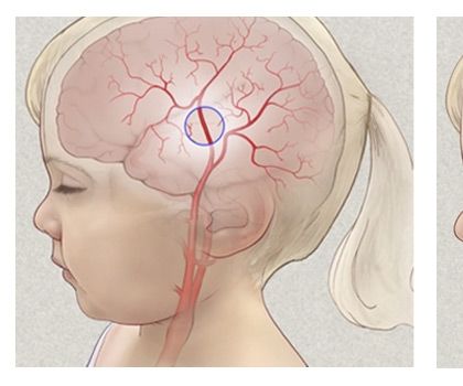 Moyamoya Image Processing
