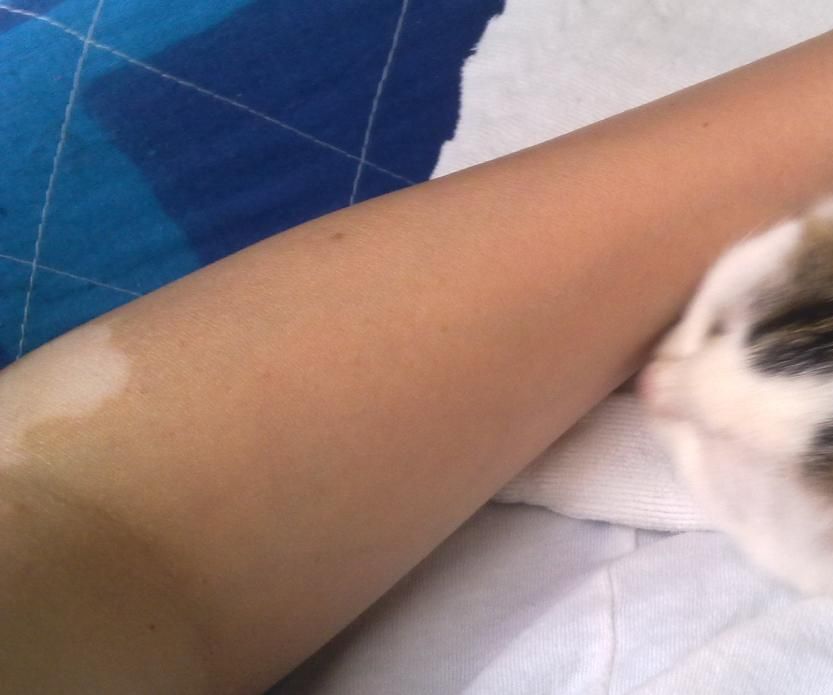 Ways to Hide a Lonely Vitiligo Spot or a Scar