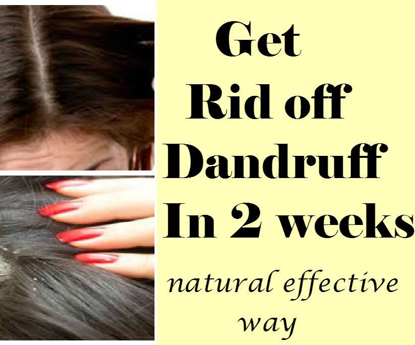 Get Rid Off Dandruff in 2 Weeks-Best & Effective Natural Way