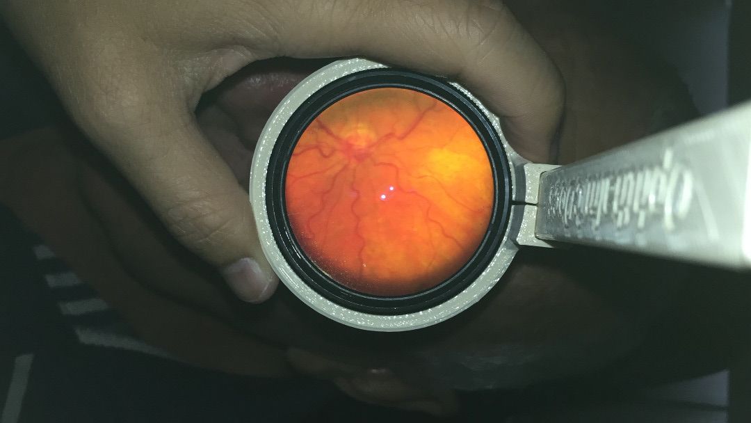Smartphone Ophthalmoscope ODocs Fundus : 3 Steps (with Pictures ...