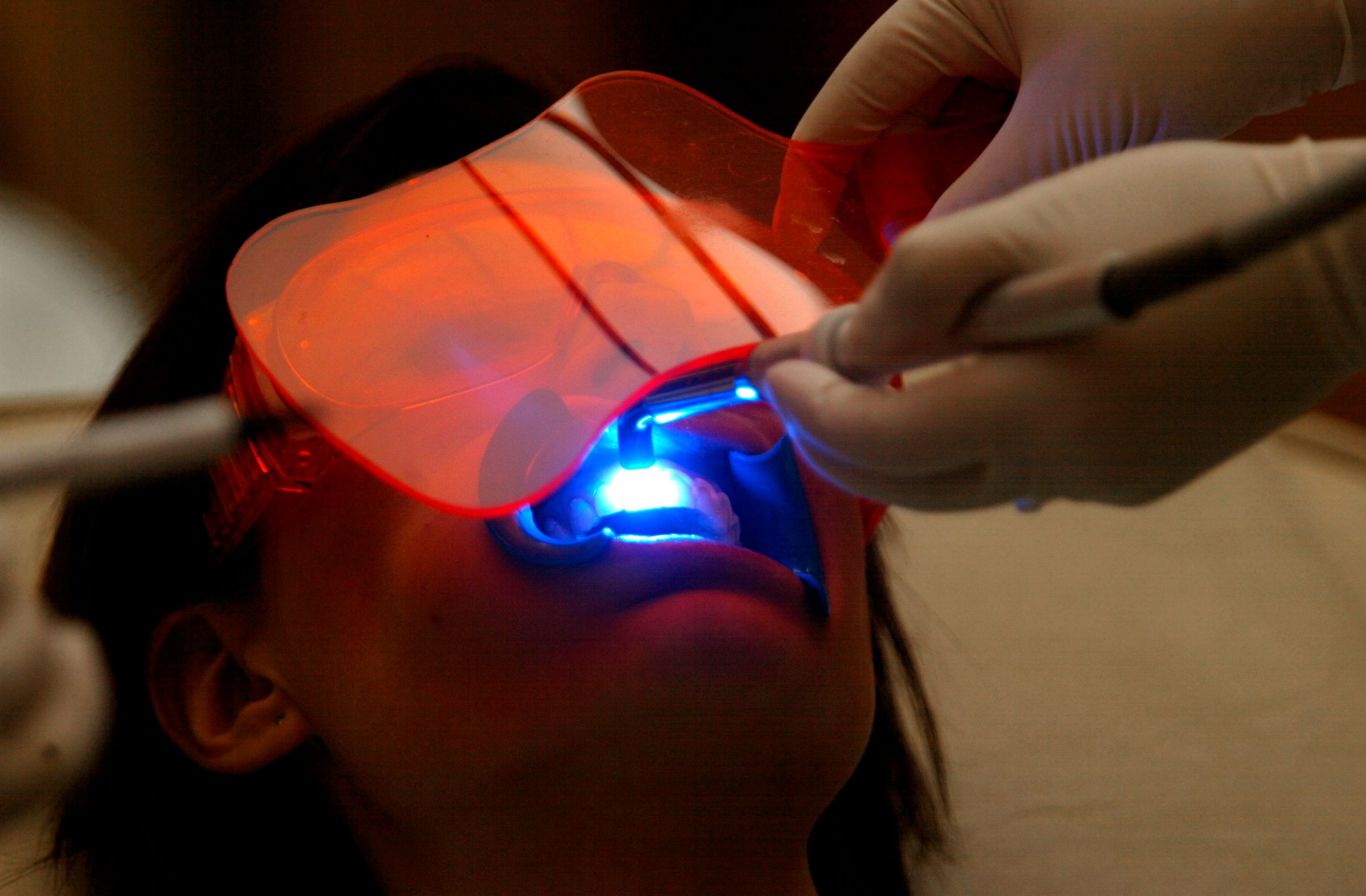 Laser Teeth Whitening in Less Than One Hour
