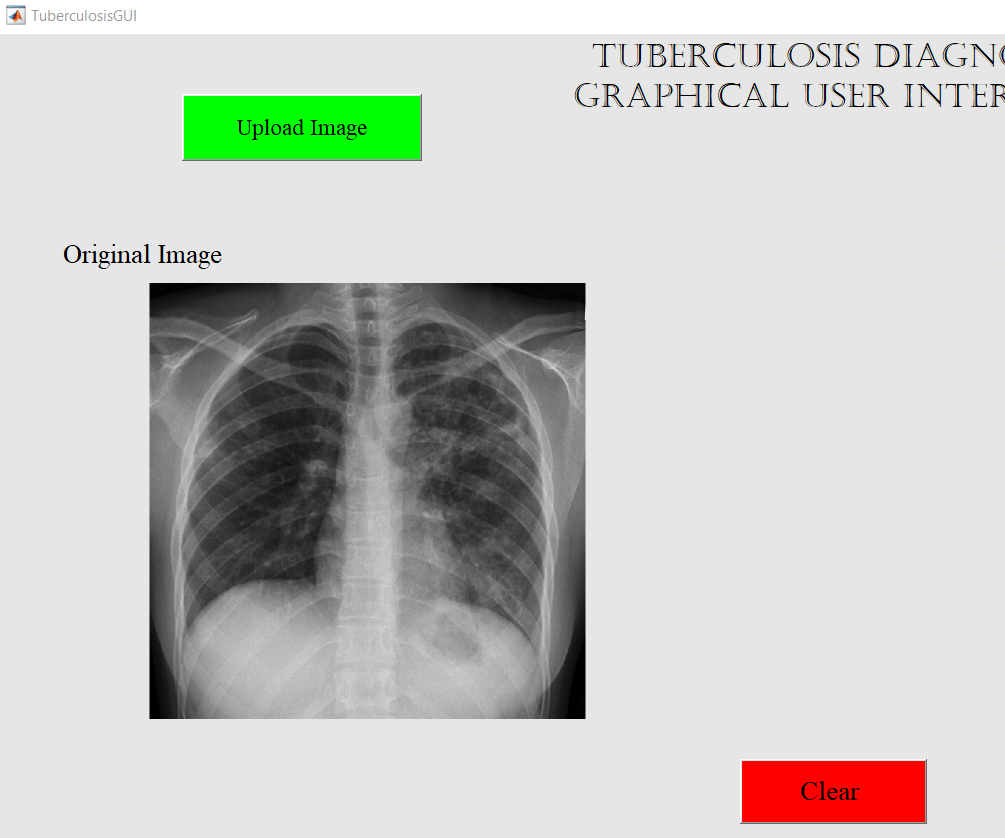 Tuberculosis Detection in X-Rays With GUI Controls