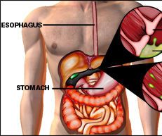Heartburn Treatment - Five Recommendations for the Way to Get Quickly Relief