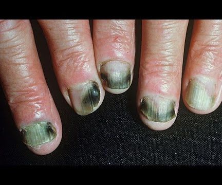 Treatment of Fingernail Fungus