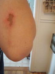 scab