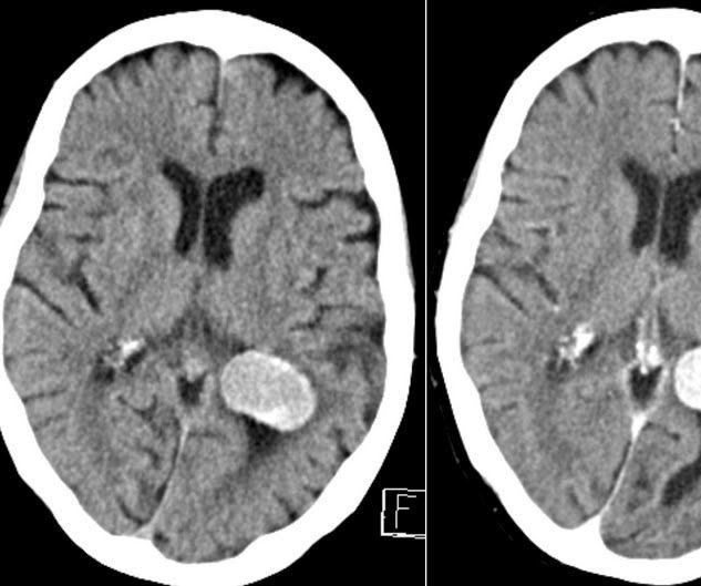 Image Processing of Brain Tumors From MRIs