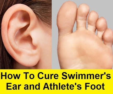 How to Cure Swimmer's Ear and Athlete's Foot