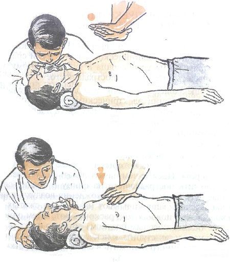 The Basic Scheme of Cardiopulmonary Resuscitation