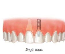 Periodontist Houston - Getting Your Gums in Line