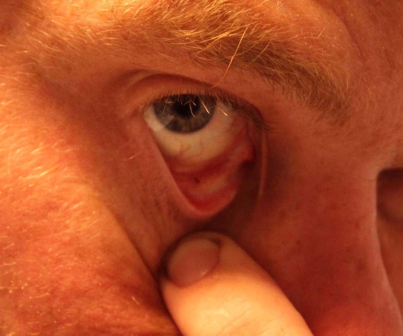 Removing Metal From the Eye