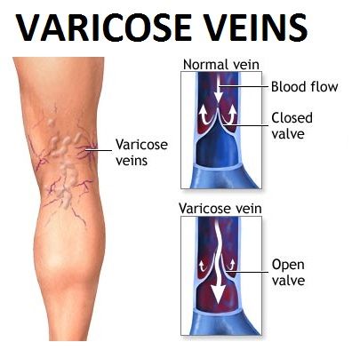 Step-by-Step Guidance for Varicose Veins and Spider Veins Treatment