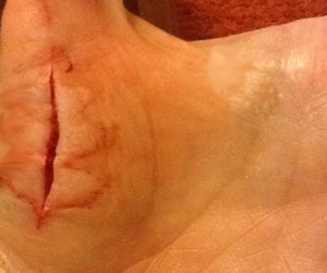 DIY Sutures