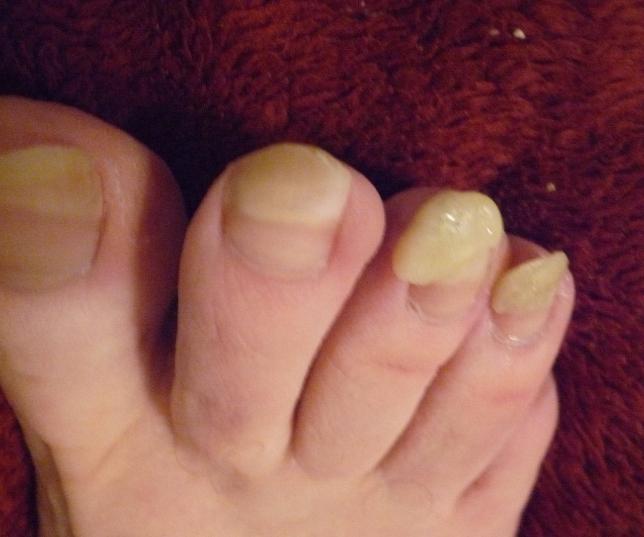 Stop Toenails Scratching/cutting.