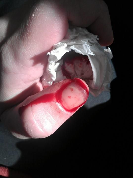 What to Do When You've Sliced Your Finger.