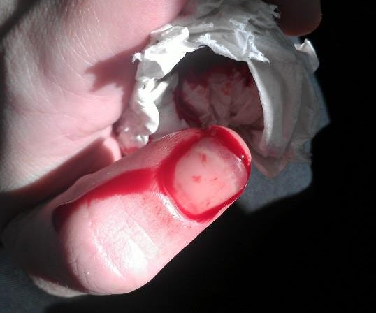 What to Do When You've Sliced Your Finger.
