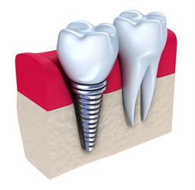 Can My Child Have Dental Implants?