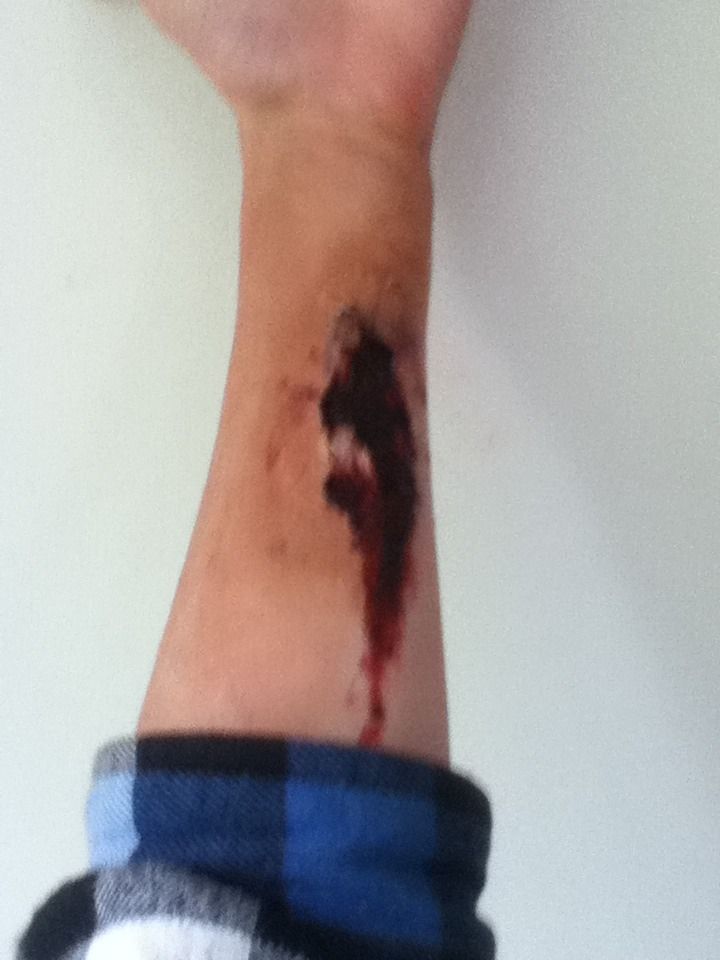 Scar on Arm