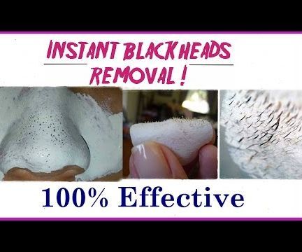 THIS One Easy Trick Can Get Rid of All Those Annoying Blackheads Instantly!