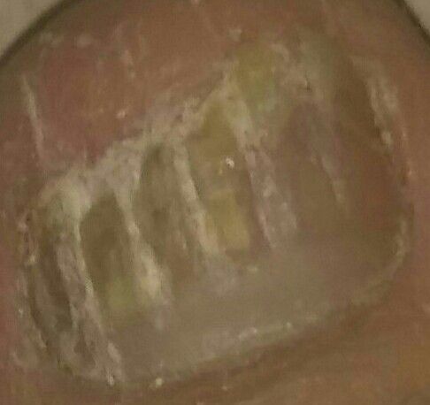 Ingrown Toenail Hack/Remedy