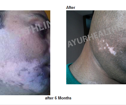 Ayurvedic Vitiligo Treatment in USA