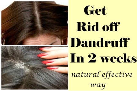 Get Rid Off Dandruff in 2 Weeks-Best & Effective Natural Way