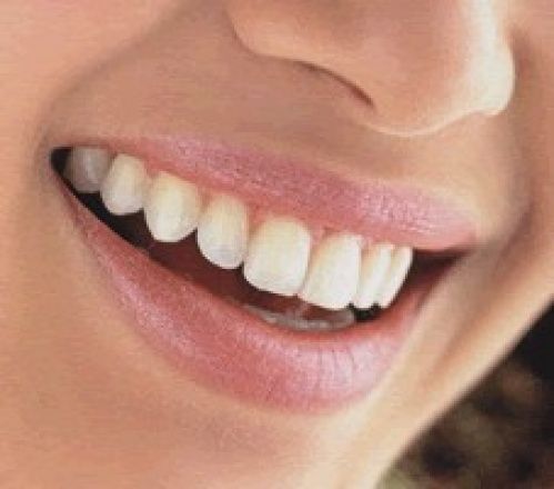 Evade Toothache by Dental Implants
