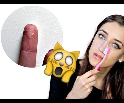 COME RIMUOVERE TUTTI I PUNTI NERI!