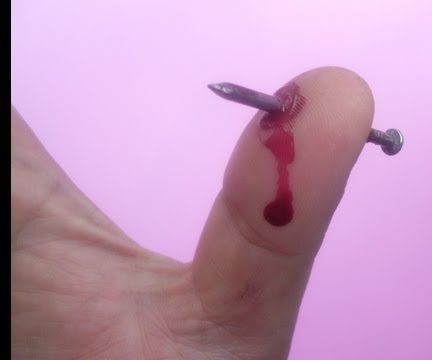 Broma Dedo Con Clavo!!!