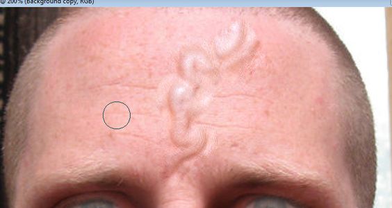Step Five: Thrombosis, or Blood Clotted Veins.