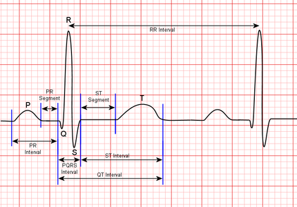 ECG Display With Arduino : 13 Steps (with Pictures) - Instructables