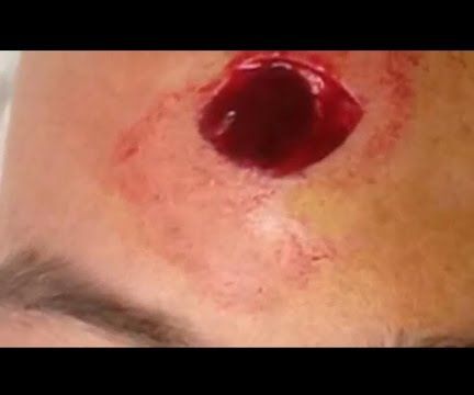 Sebaceous Cysts Recommendations and Their Treatment