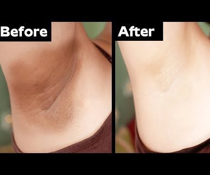 How to Lighten Dark Underarms Permanently | PlayEven English