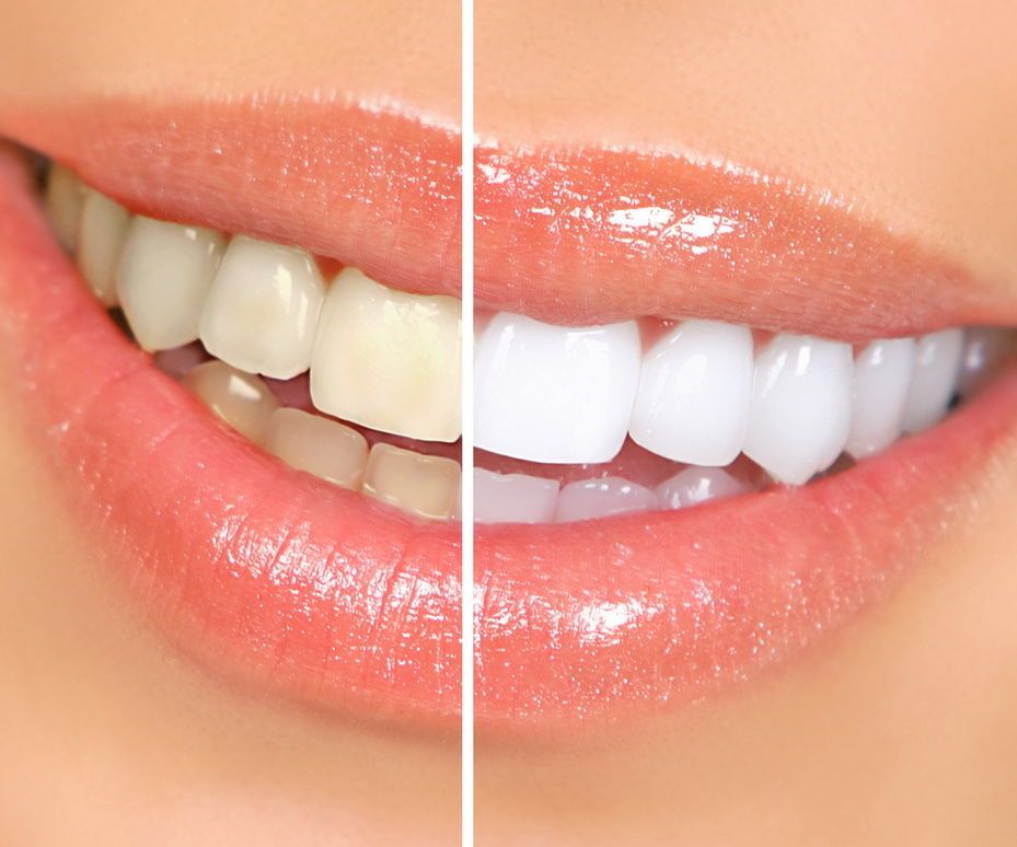 Natural Ways to Whiten Your Teeth