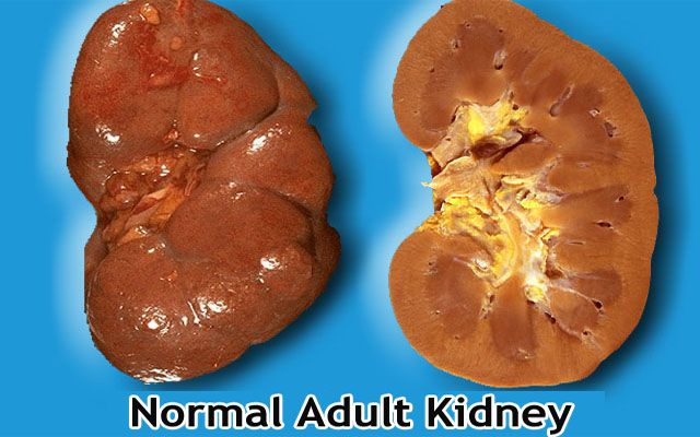 Ways to Prevent Kidney Disease