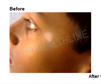 White Patches on Skin – Diagnosis and Treatment