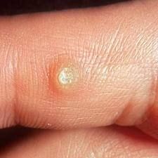 Get Rid of Warts