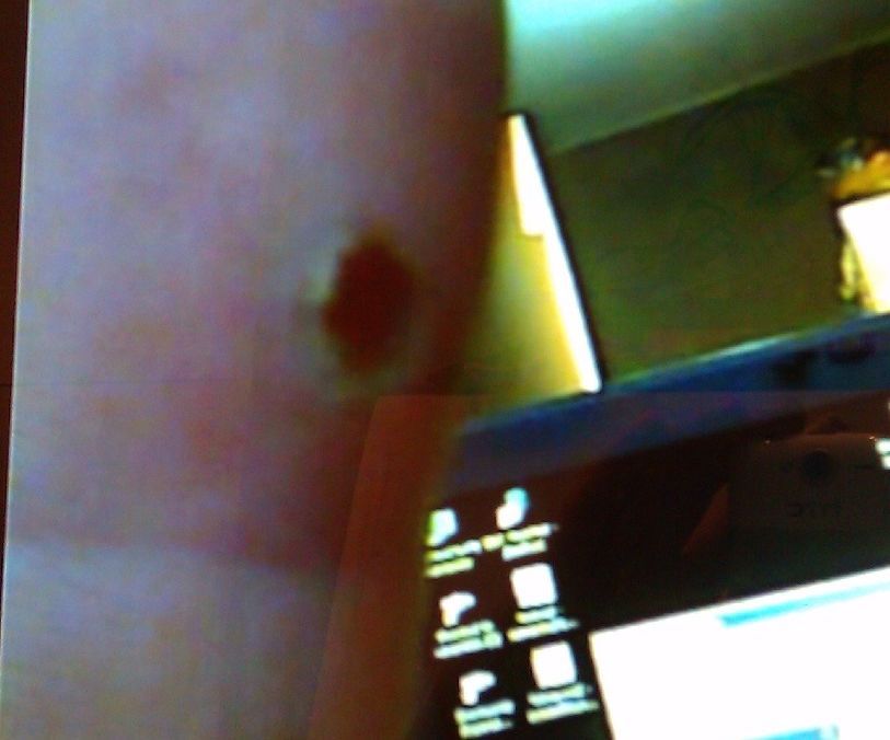 Wart Removal - the Less Toxic Method